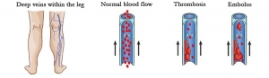 thrombosis, blood clot or embolus compared to normal blood flow