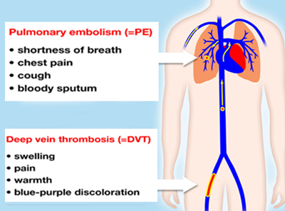 Severe symptoms of a blood clot or deep vein thrombosis