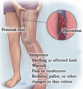 Symptoms of blood clots or deep vein thrombosis