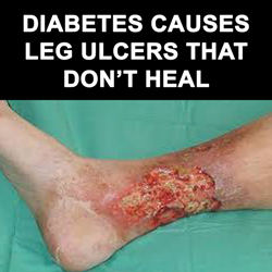 Diabetes causes ulcers