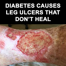 Diabetes causes ulcers