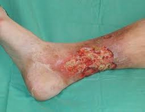 Leg ulcer from diabetes