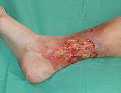 Leg ulcer from diabetes